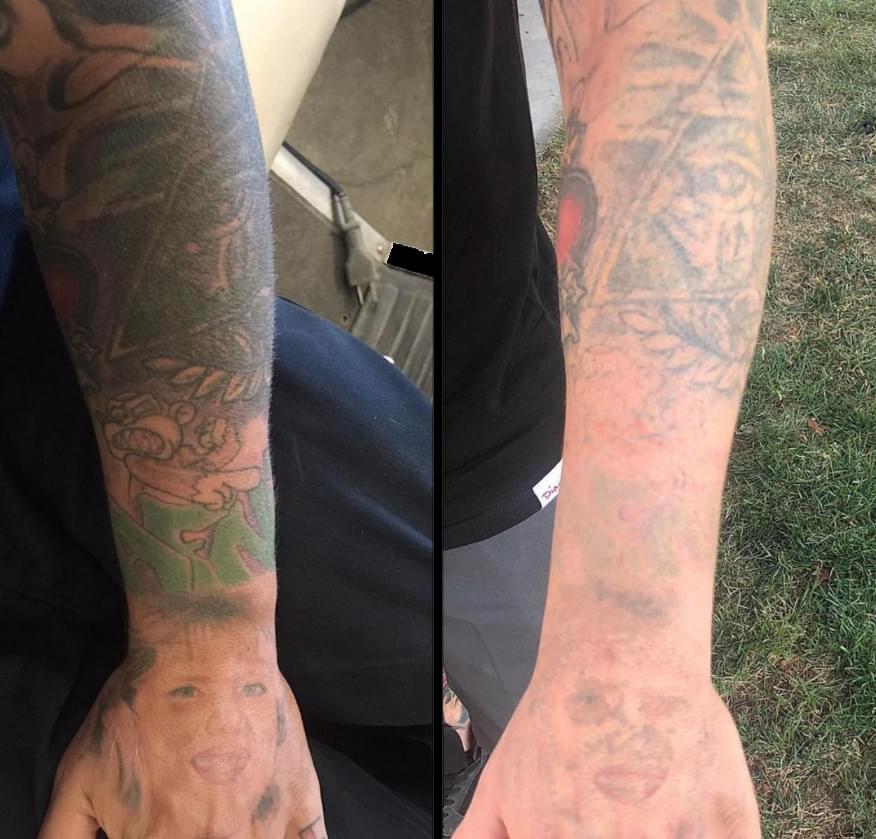 Before and after laser tattoo removal of a forearm sleeve, Gold Coast