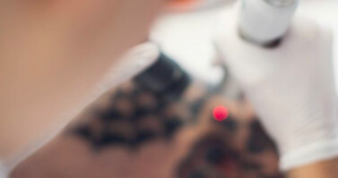 Tattoo Removal Results and Timeline Explained - White Diamond Laser Tattoo Removal Gold Coast