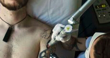 6 Myths About Laser Tattoo Removal Put to Rest - White Diamond Laser Tattoo Removal Gold Coast
