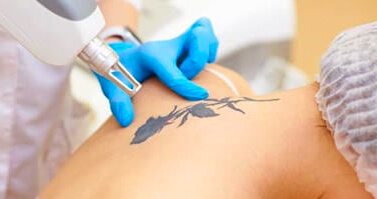 Laser Tattoo Removal Benefits