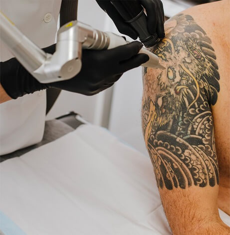 Laser tattoo removal treatment at White Diamond Laser